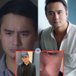 OMG! Kim Chiu NAGSALITA Tungkol sa Pagkakalpo ni Vice Ganda Dahil sa Pagbaba ng Platelet Count Habang Nagsu-Shooting ng It’s Showtime!